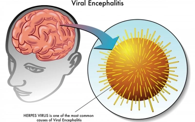 Εγκεφαλίτιδα: Η «ύπουλη» φλεγμονή του εγκεφάλου – Τα πρώτα συμπτώματα